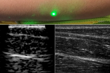 Los investigadores producen las primeras imágenes de ultrasonido con láser de humanos